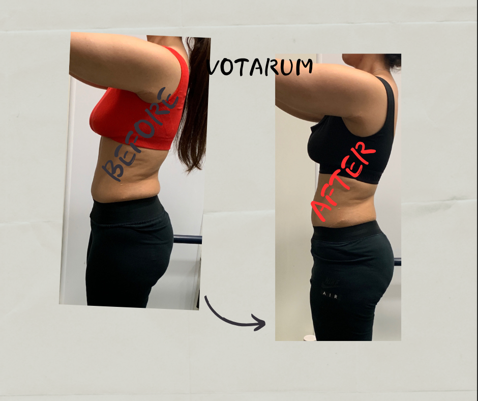 Before After 4